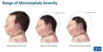 Microcephaly Secerity 420x213